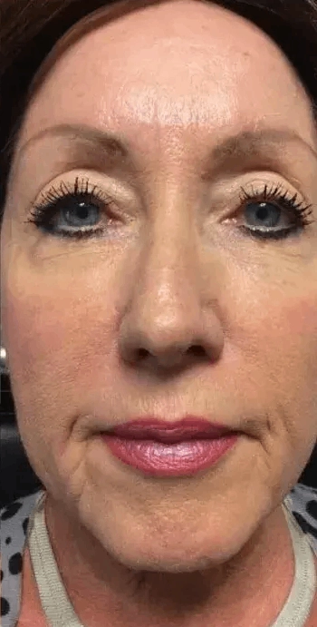 Perioral softening and lip definition, after (Injectable treatment)