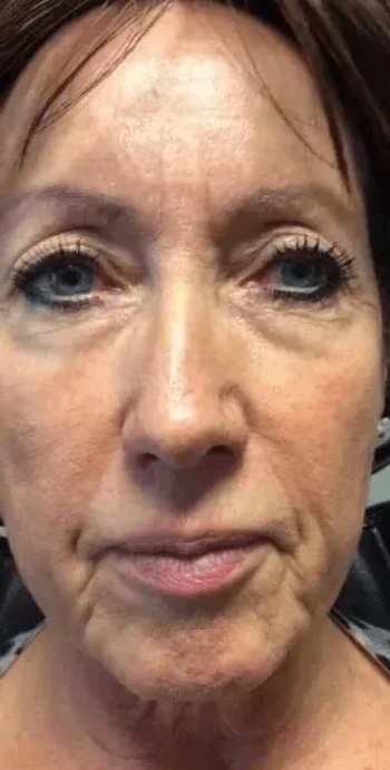 Perioral softening and lip definition, before (Injectable treatment)