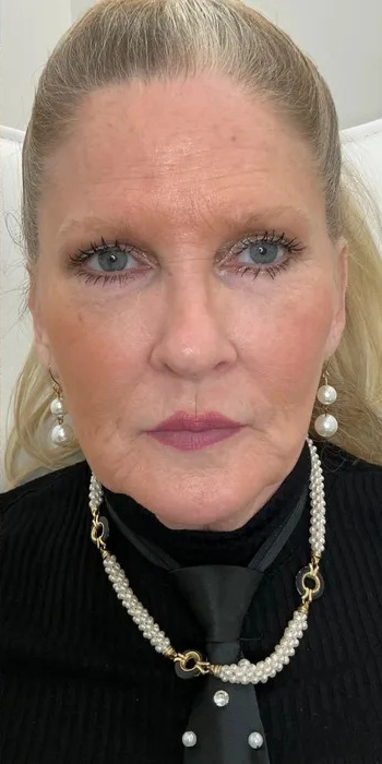 Midface support and lip volume, after (Injectable treatment)
