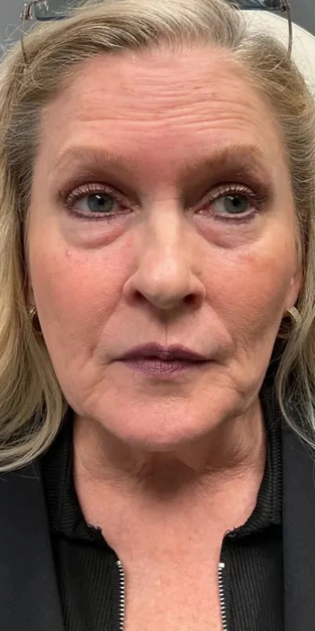 Midface support and lip volume, before (Injectable treatment)