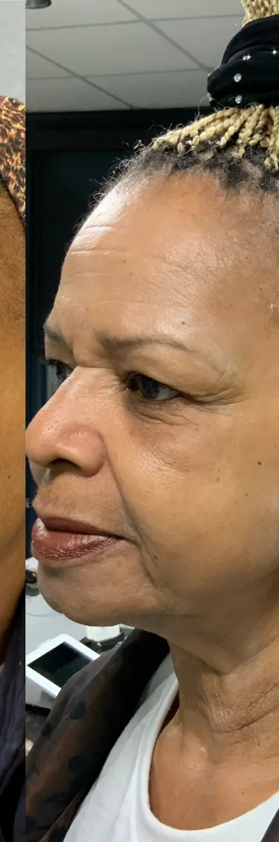 One LaseMD treatment, photographed over six weeks, about 6 weeks (LaseMD)