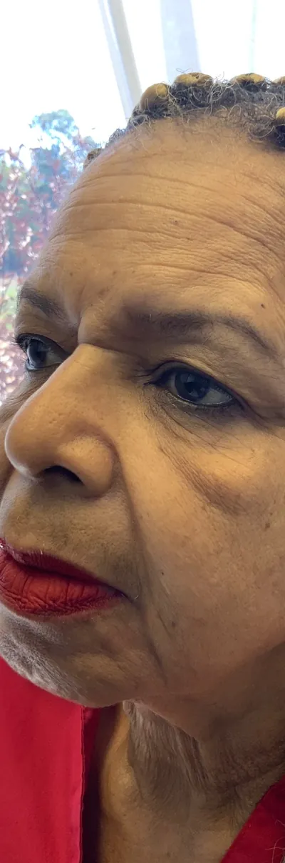One LaseMD treatment, photographed over six weeks, before (LaseMD)