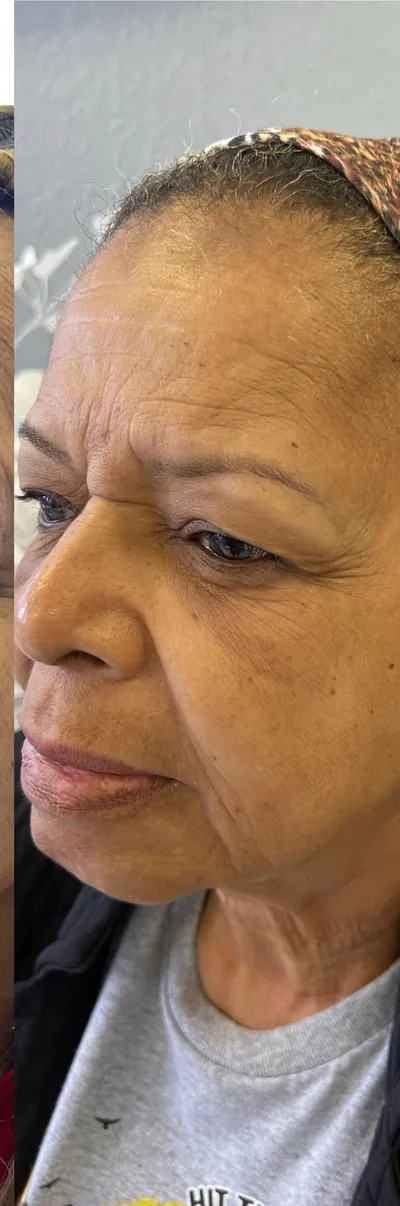 One LaseMD treatment, photographed over six weeks, in between (LaseMD)