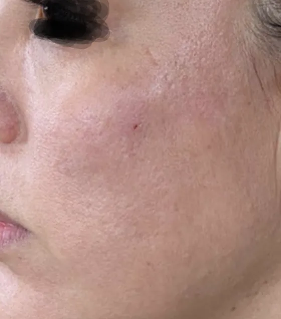 Cheek texture, close range, after (Laser resurfacing)