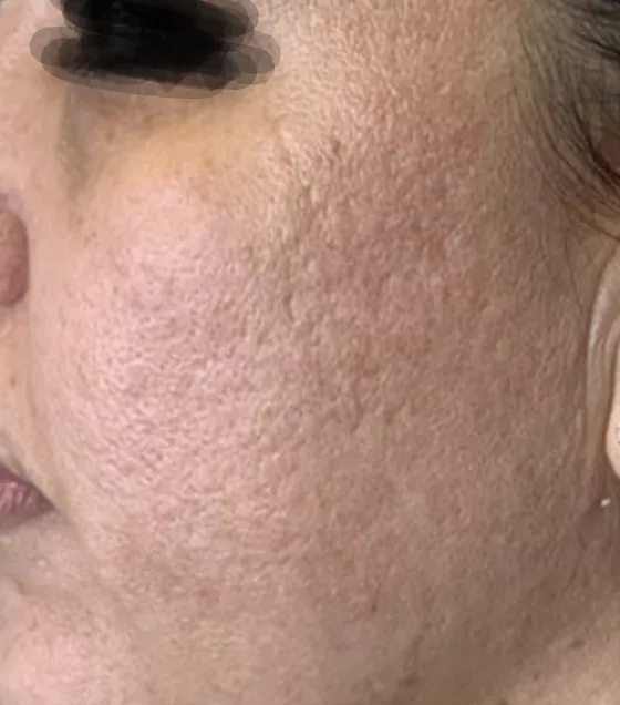 Cheek texture, close range, before (Laser resurfacing)