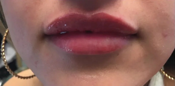 Lip enhancement, close range, after (Dermal filler)