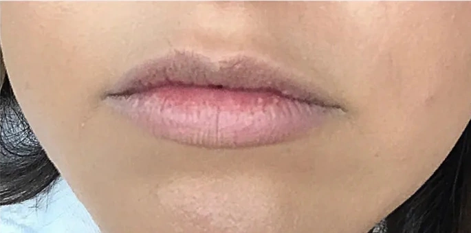 Lip enhancement, close range, before (Dermal filler)