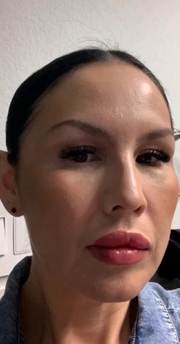 Lip filler with a LaseMD series, after (Dermal filler + LaseMD (3 treatments))
