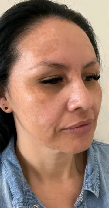 Lip filler with a LaseMD series, before (Dermal filler + LaseMD (3 treatments))