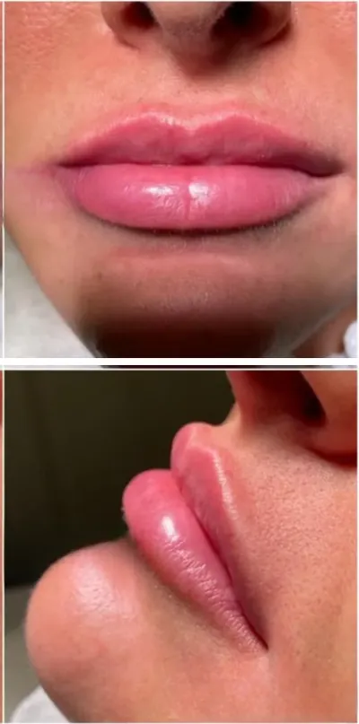 Lip enhancement, front and profile, after (Dermal filler)