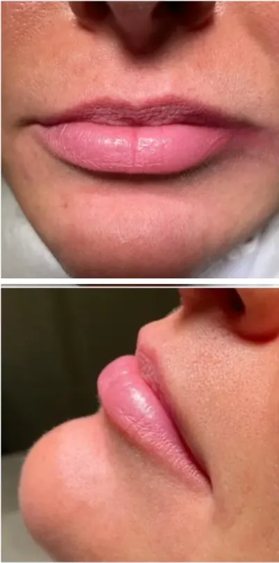 Lip enhancement, front and profile, before (Dermal filler)