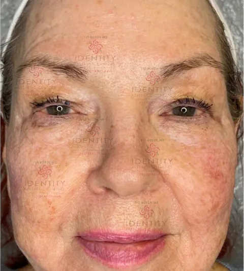 Brow, lid and lower-face support, after (PDO thread lift)