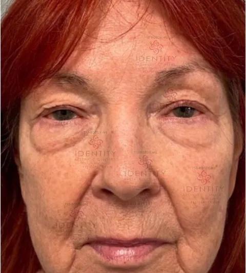 Brow, lid and lower-face support, before (PDO thread lift)
